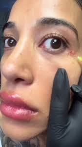 Lumi Eyes After 3 Sessions