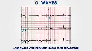 Or >25% of associated r wave; Ø¯ Ù…ÙˆØ±ÙÙŠÙ† On Twitter Q Waves Isolated Q Waves Can Be Normal A Pathological Q Wave Is 25 The Size Of The R Wave That Follows It Or 2mm In Height