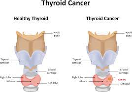 Most forms of thyroid cancer are easily treated. Detecting And Treating Thyroid Cancer Cardiac Screen