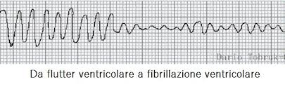 A causa di questo la fuoriuscita del sangue da. Le Principali Aritmie Cardiache Al Tracciato Ecg Spiegate In Modo Semplice