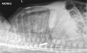 Chest Lateral Decubitus View Radiology Reference Article Radiopaedia Org