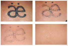 It is gentle on the skin. Permanent Tattoo Removal Services Laser Treatment Center à¤² à¤à¤° à¤ à¤° à¤à¤® à¤ à¤² à¤ à¤° à¤ à¤° à¤à¤® à¤ In Gki Basement Delhi Flasers Id 9419375297