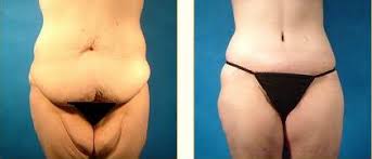 Thigh Lift Dr Lomonaco Plastic Surgery Houston Tx