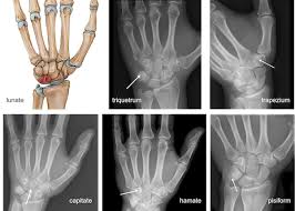 Image result for Pisiform Bone