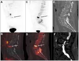 The american cancer society provides detailed information on prostate cancer and its treatment. 68ga Psma Pet Ct For The Detection Of Bone Metastasis In Recurrent Prostate Cancer And A Psa Level 2 Ng Ml Two Case Reports And A Literature Review