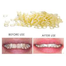 100 Pcs Dental Rubber Bands Orthodontic Elastics Braces Teeth Gap Walmart Com Walmart Com