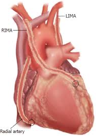 We did not find results for: Total Arterial Coronary Grafting Outcomes Concerns And Controversies