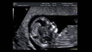 Measure the embryo using crown rump morphology scan assessments. Ultrasound Dating Measurements