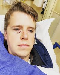 Accidentally took a power drill to my face.