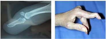 Webmd explains treatment and complications. Mallet Finger Treatment Service Cholesterol Treatment à¤® à¤¡ à¤•à¤² à¤Ÿ à¤° à¤Ÿà¤® à¤Ÿ à¤¸à¤° à¤µ à¤¸ à¤š à¤• à¤¤ à¤¸ à¤‰à¤ªà¤š à¤° à¤¸ à¤µ à¤ In Pune Pune Dr Sachin Tapasvi Id 19973120797