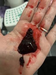 We did not find results for: Blood Clot Or Miscarriage Mnhq Graphic Pic Warning Mumsnet