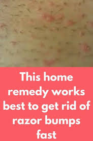 This Home Remedy Works Best To Get Rid Of Razor Bumps Fast Prevention Is Always Better Than Cure Waxing Is Razor Bumps Razor Bump Treatment Razor Bumps Bikini