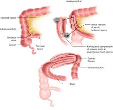 Image result for Intussusception