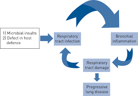 bronchiectasis ers