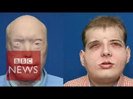 The 'world's most extensive' transplant