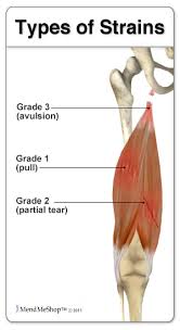 Read more below to learn about upper leg pain, including causes, possible treatments, and more. Groin Tendinitis