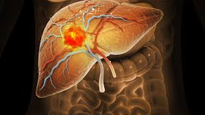 Medical illustration of the liver with a highlighted tumor mass and visible hepatic blood vessels