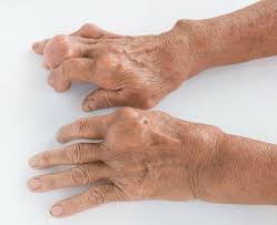 Image result for gout