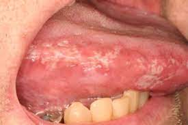 Adverse Drug Events In The Oral Cavity Sciencedirect