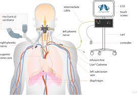Schematic Representation Of The Lungpacer Live Catheter System Download Scientific Diagram