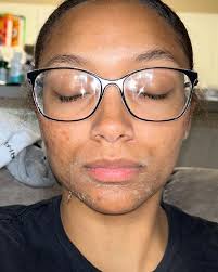 Hannah Luke,LE LAP (@skin_byhannah) • Instagram photos and videos