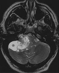 Acoustic neuroma or schwannoma vestibular is benign tumour from. Unusual Lesions Of The Cerebellopontine Angle A Segmental Approach Radiographics