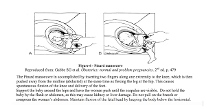 Image result for Breech Delivery