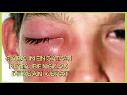 Menatap layar komputer atau televisi dapat menyebabkan kelelahan mata, jadi dokter mungkin mengharuskan anda untuk beristirahat dengan mata tertutup selama sehari atau lebih. Cara Mengobati Sakit Mata Yang Membengkak Bisabo Channel