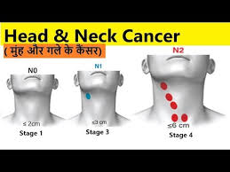 If it has spread anywhere nearby, such as the lymph nodes in the neck. Head Neck Cancer In Hindi à¤—à¤² à¤—à¤° à¤¦à¤¨ à¤• à¤¨ à¤¨ à¤• à¤• à¤• à¤¸à¤° à¤• à¤²à¤• à¤·à¤£ Stages à¤œ à¤š à¤‡à¤² à¤œ Survival Youtube