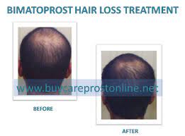 The hair growth phase is composed of three. Bimatoprost Hair Loss Before And After Order Careprost Online For Longer Eyelashes At Reasonable Price In Usa Buy Careprost 18 33 Only With Free Shipping