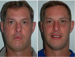 Miami Plastic Surgeon And Rhinoplasty Specialist Rhinoplasty Facial Plastic Surgery Cosmetic Surgery