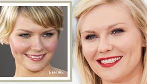 How to change your asymmetrical smile to symmetrical one. 45 Invisalign Ideas Invisalign Braces Alternative Orthodontics