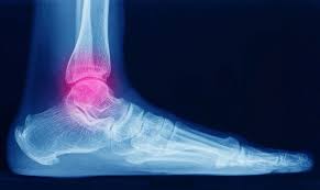Image result for Ankle XRay