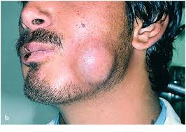 Image result for phlegmon on face)