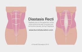 Separated Stomach Muscles Mummy Tummy Art Love Fashion Diastasis Recti Diastasis Stomach Muscles