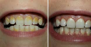 Como Eliminar El Sarro De Los Dientes En 5 Minutos