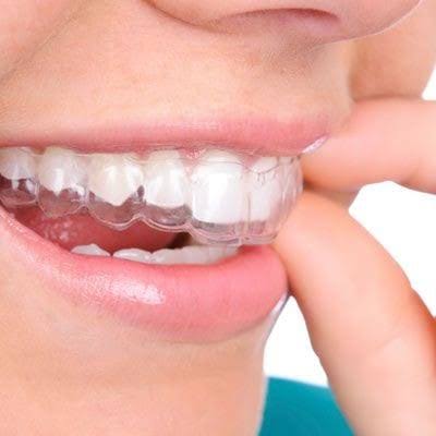 Invisalign Lite Package product image