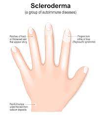 Scleroderma | Advocate Health Care