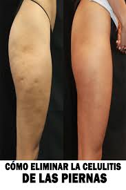 Como Eliminar La Celulitis De Las Piernas Y Gluteos Rapidamente Pin On Salud Y Bienestar