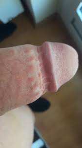 Wenn das vorhautbändchen durchreißt kann es zu schmerzen und einer starken blutung kommen, aufgrund der arteria frenularis welche. Fragen Hautverletzungen Infolge Beschneidung Postoperative Komplikationen Der Beschneidung Beschneidungsforum De