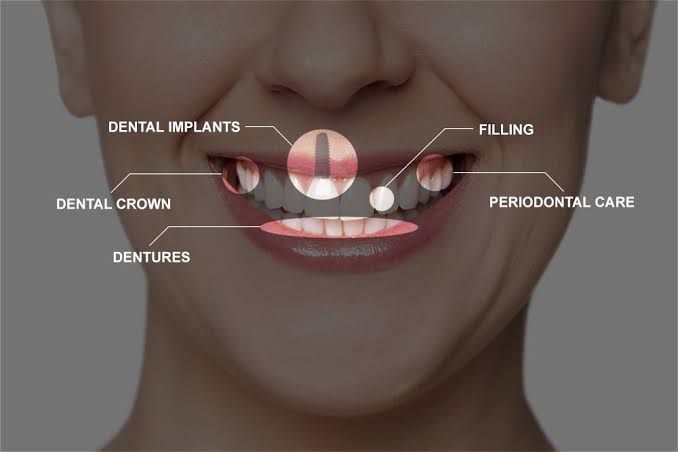 Full Mouth Reconstruction Recovery - Birmingham, AL