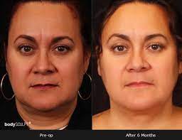 Developed by body sculpt ® 's founder and surgical director, dr. Embracerf Before And Photos Bodysculpt