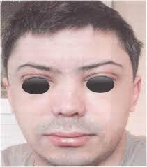 Idiopathic nonhistaminergic acquired angioedema.