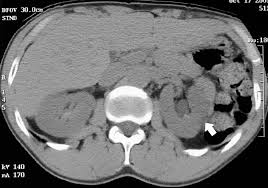 Image result for Nephrolithiasis Imaging
