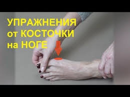 можно ли избавиться от косточки на ноге без операции Pin Na Doske Zdorove