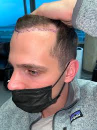 Dr. Hasson Consultation