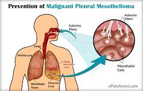 (naturalnews) mesothelioma doesn't have to be fatal. Life Expectancy In Malignant Pleural Mesothelioma Its Prognosis And Prevention