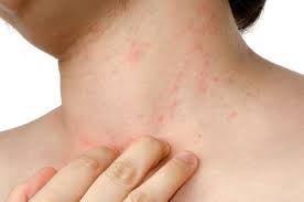 Ada Ruam Merah Di Tubuh Waspadai Psoriasis Yang Bisa Membahayakan Semua Halaman Nakita