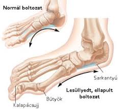 Képtalálat a következőre: „bütyök kalapácsujj képek”