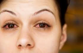 Image result for Allergic Conjunctivitis